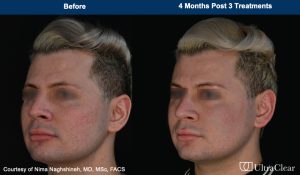UltraClear Before and After Photos