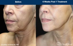 UltraClear Before and After Photos
