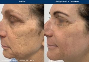 UltraClear Before and After Photos